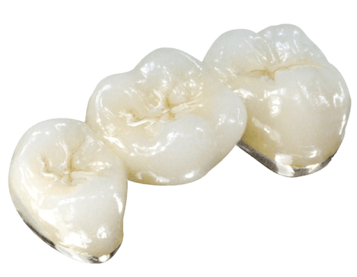 3-unit PFM dental bridge made of white alloys