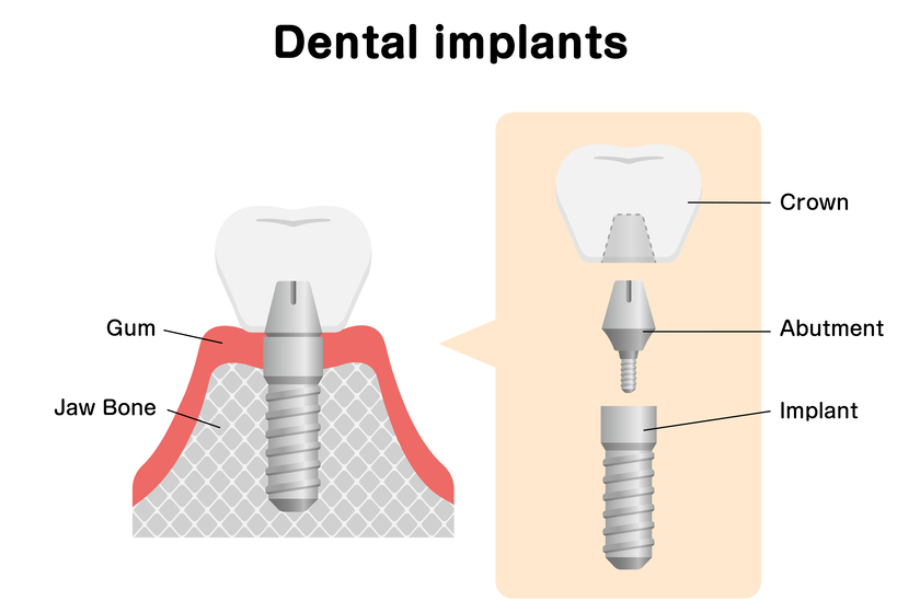 Dental implant flat vector illustration