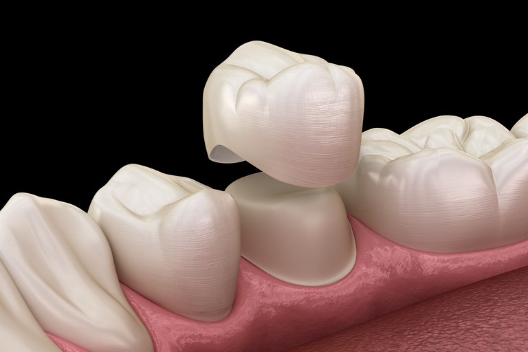 Metal Dental Crowns: Pros And Cons In Restorative Dentistry